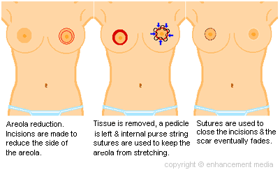  areola reduction results