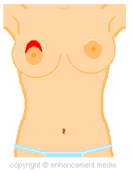 benelli breast lift image